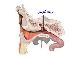 استئومای مجرای گوش چیست؛ علل، عوارض و درمان