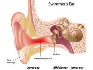 بیماری گوش شناگر چیست و چگونه درمان می شود؟