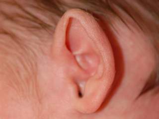 بدشکلی گوش خارجی؛ علل و درمان