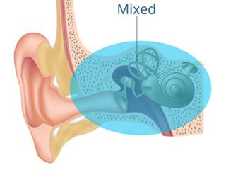 کم شنوایی آمیخته چیست و چگونه درمان می شود؟