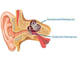 کم شنوایی حسی عصبی چیست؛ علل و علائم و درمان